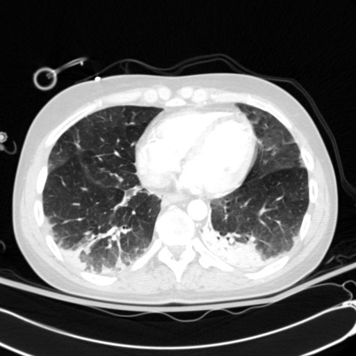 Acute myocardial infarction in CT (Radiopaedia 39947-42415 Axial lung window 93).jpg