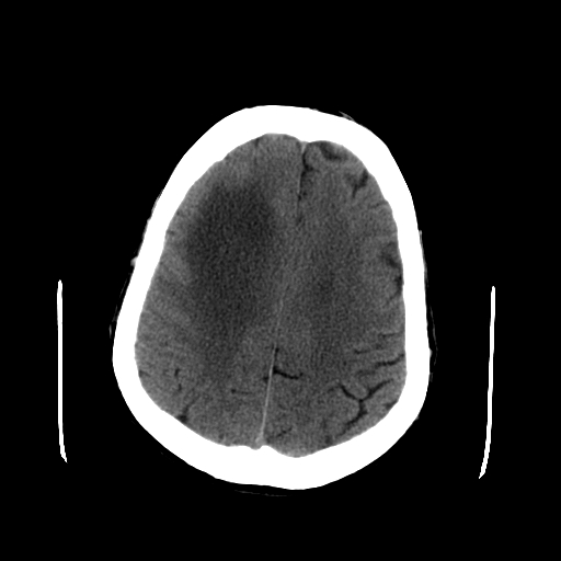 File:Acute necrotizing toxoplasma encephalitis (Radiopaedia 10683-11150 Axial non-contrast 11).jpg