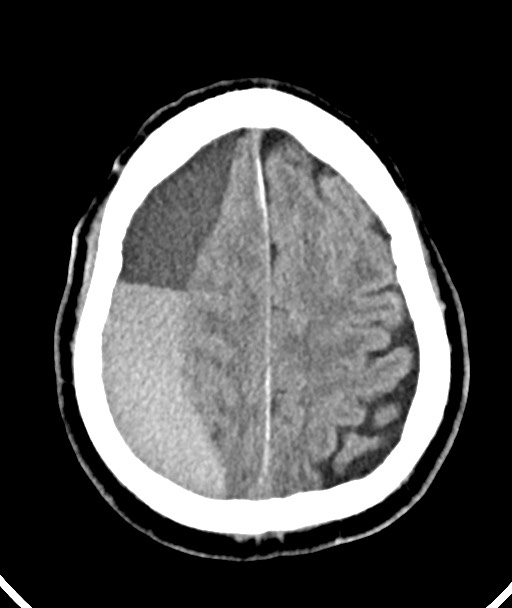 Acute on chronic subdural hematoma (Radiopaedia 78346-90966 Axial non-contrast 45).jpg