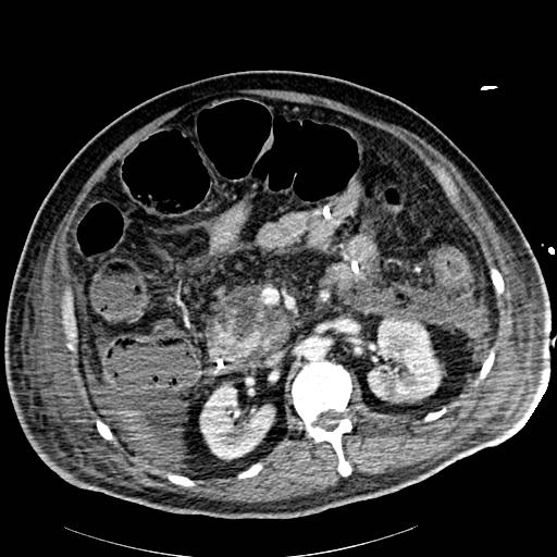 File:Acute pancreatic necrosis (Radiopaedia 13560-18502 Axial C+ portal venous phase 36).jpg