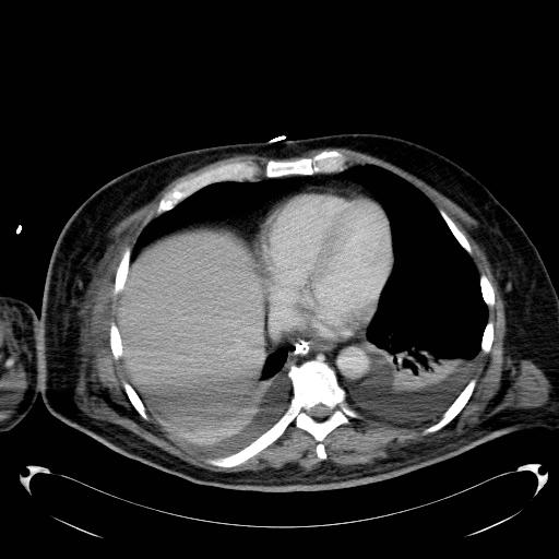 Acute pancreatic necrosis (Radiopaedia 13560-18503 Axial C+ portal venous phase 1).jpg