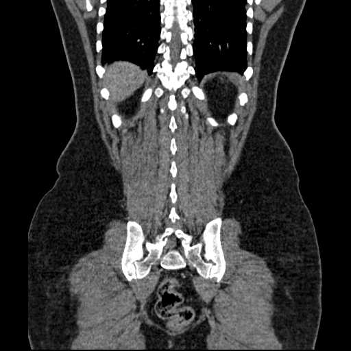 File:Acute pancreatitis (Radiopaedia 20829-20744 Coronal C+ portal venous phase 45).jpg
