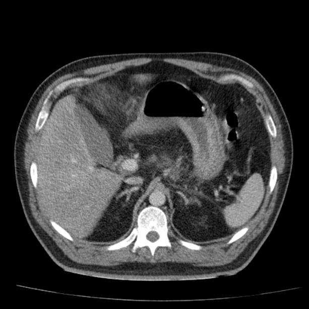 Acute pancreatitis (Radiopaedia 26663-26813 Axial C+ portal venous phase 22).jpg