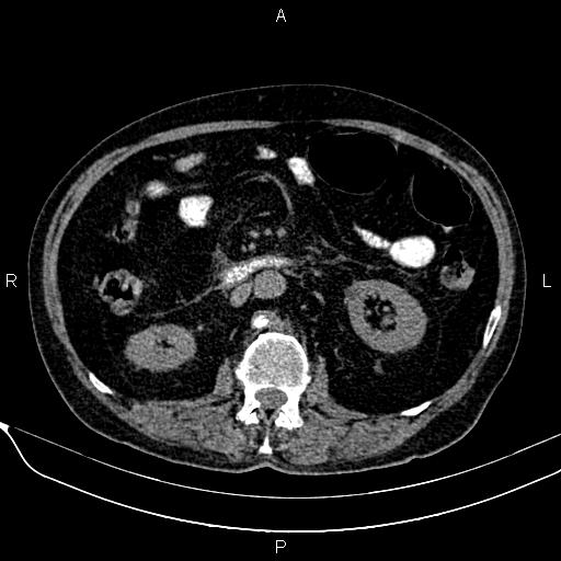 Acute pancreatitis (Radiopaedia 85146-100701 Axial non-contrast 59).jpg