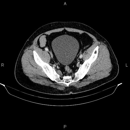 Acute pancreatitis (Radiopaedia 85390-101010 Axial C+ portal venous phase 90).jpg