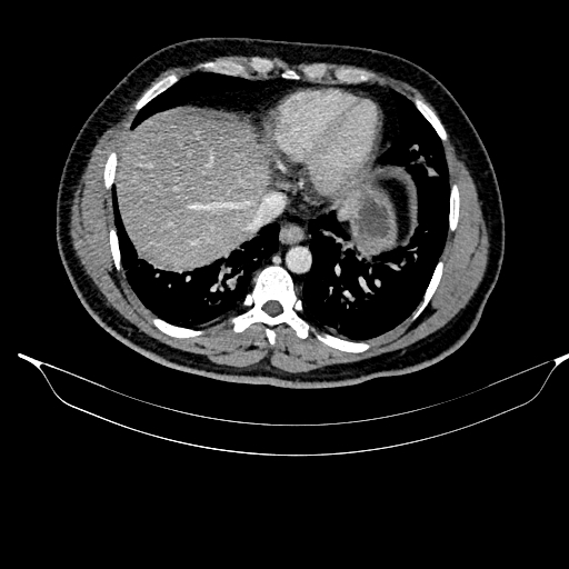 Acute pancreatitis (Radiopaedia 87428-103757 Axial C+ portal venous phase 17).jpg