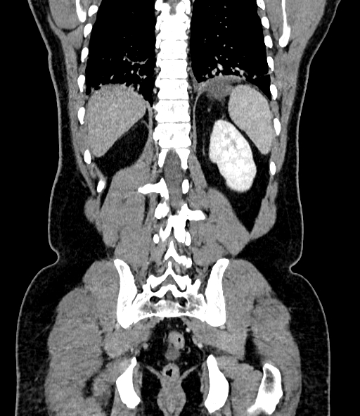 Acute pancreatitis (Radiopaedia 87428-103757 Coronal C+ portal venous phase 72).jpg