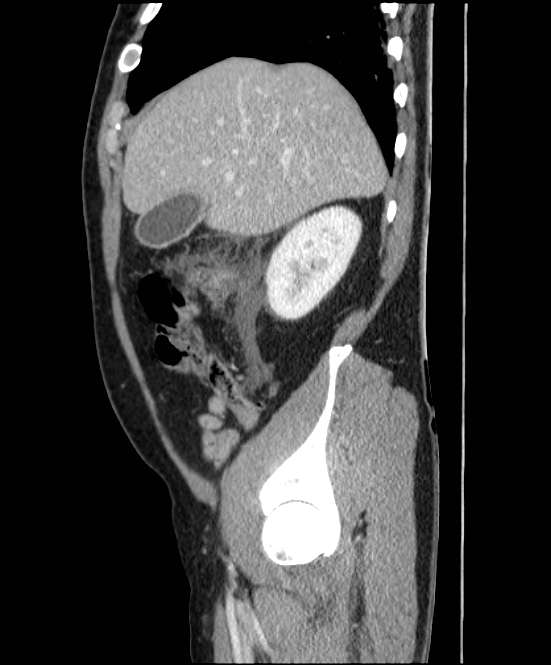 Acute pancreatitis - Balthazar E (Radiopaedia 23080-23110 Sagittal C+ portal venous phase 20).jpg
