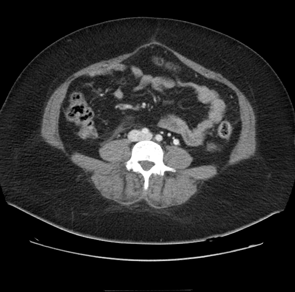 Acute pancreatitis - Balthazar E (Radiopaedia 29016-29377 Axial C+ portal venous phase 44).png