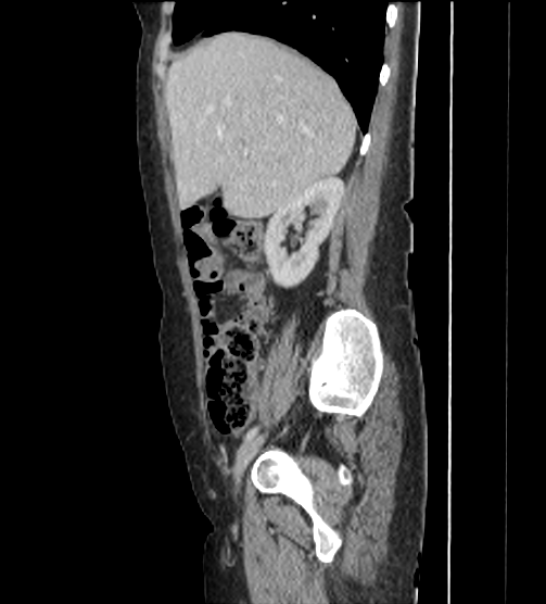 Acute pancreatitis - Balthazar E - post ERCP (Radiopaedia 27562-27772 Sagittal C+ portal venous phase 34).png