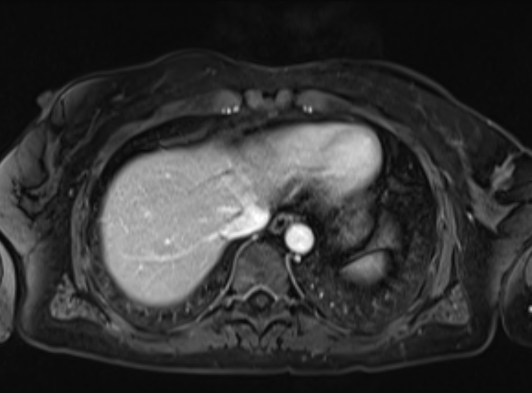 File:Acute pancreatitis - Balthazar E - post ERCP (Radiopaedia 27562-27778 F 15).png