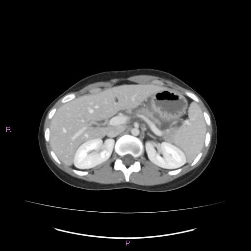 Acute pancreatitis secondary to stone at minor papilla and pancreatic divisum (Radiopaedia 76570-88333 Axial C+ portal venous phase 23).jpg