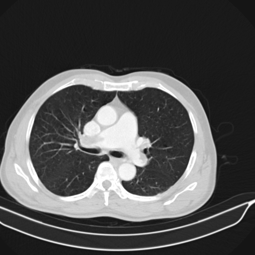 Acute pulmonary embolism (Radiopaedia 69510-79390 Axial lung window 1).jpg
