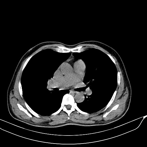 File:Acute pulmonary embolism (Radiopaedia 69510-79390 Axial non-contrast 12).jpg