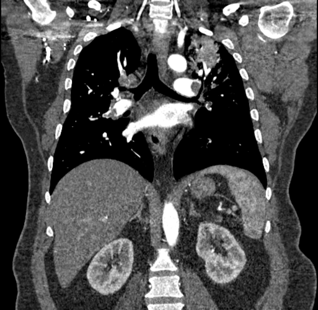 Acute pulmonary embolism with pulmonary infarcts (Radiopaedia 77688-89908 Coronal C+ CTPA 57).jpg
