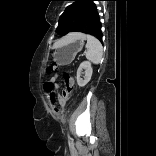 Acute pyelonephritis (Radiopaedia 25657-25837 Sagittal renal parenchymal phase 60).jpg