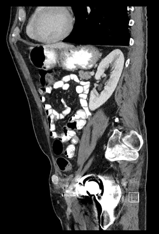Acute renal infarction - rim capsular enhancement (Radiopaedia 59833-67270 Sagittal C+ portal venous phase 34).jpg