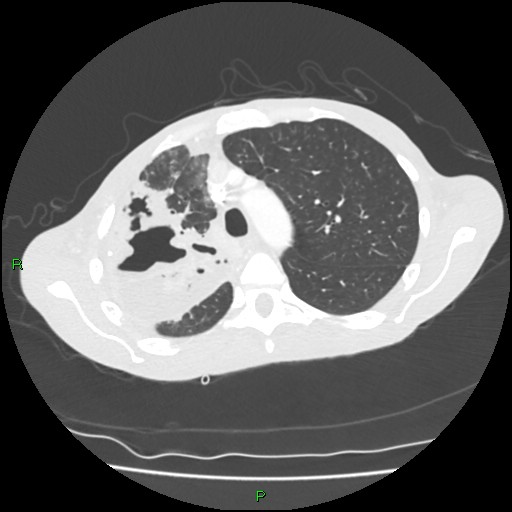 File:Acute right lung abscess (Radiopaedia 34806-36258 Axial lung window 52).jpg