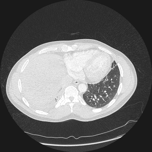 Acute segmental pulmonary emboli and pulmonary infarction (Radiopaedia 62264-70444 Axial lung window 152).jpg