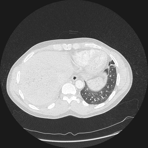 Acute segmental pulmonary emboli and pulmonary infarction (Radiopaedia 62264-70444 Axial lung window 162).jpg