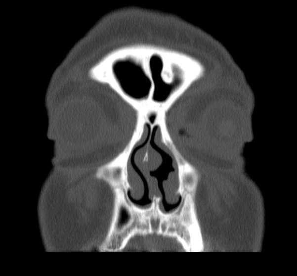 File:Acute sinusitis (Radiopaedia 23161-23215 Coronal bone window 22).jpg