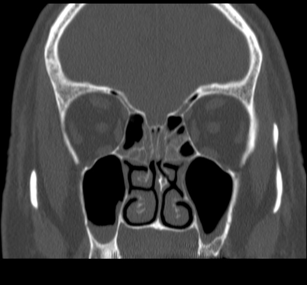 Acute sinusitis (Radiopaedia 23161-23215 Coronal bone window 36).jpg