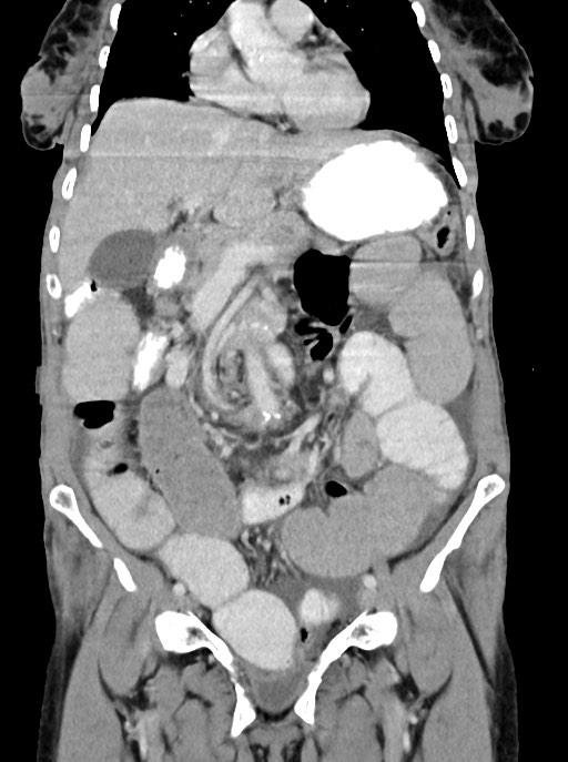 Acute small bowel (ileal) volvulus (Radiopaedia 71740-82139 Coronal C+ portal venous phase 47).jpg