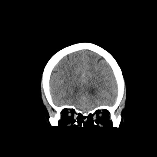 Acute subarachnoid hemorrhage and accessory anterior cerebral artery (Radiopaedia 69231-79008 Coronal non-contrast 22).jpg