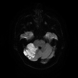 Acute superior cerebellar artery territory infarct (Radiopaedia 84104-99358 Axial DWI 57).jpg