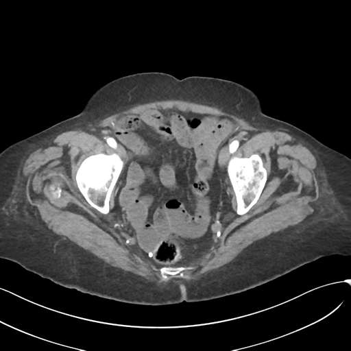 File:Acute superior mesenteric artery occlusion (Radiopaedia 43926-47418 Axial C+ portal venous phase 60).png