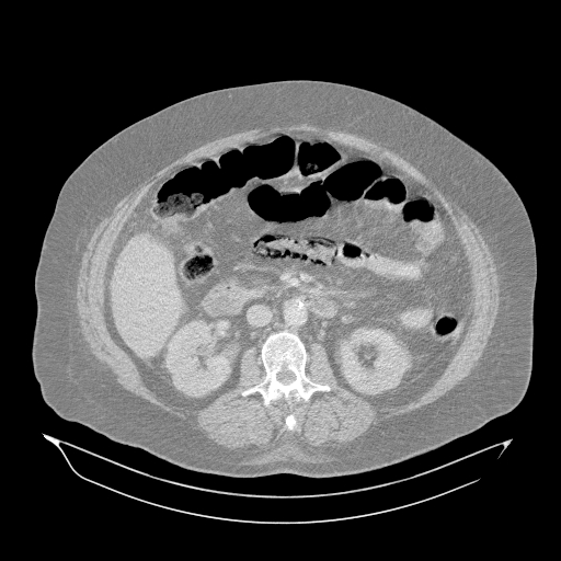 File:Acute superior mesenteric artery occlusion (Radiopaedia 51288-56960 Axial lung window 24).jpg