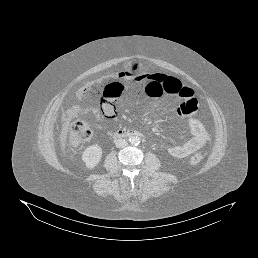 File:Acute superior mesenteric artery occlusion (Radiopaedia 51288-56960 Axial lung window 34).jpg