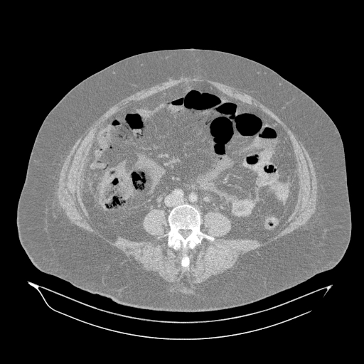 Acute superior mesenteric artery occlusion (Radiopaedia 51288-56960 Axial lung window 39).jpg