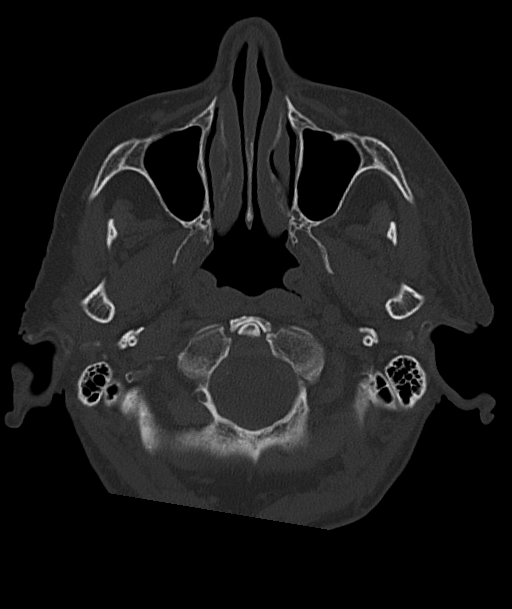 Acute traumatic subdural hematoma (Radiopaedia 82921-97257 Axial bone window 96).jpg