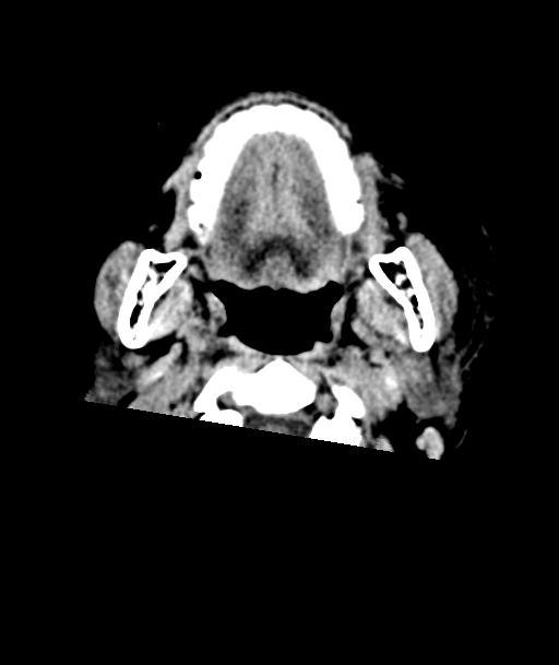 Acute traumatic subdural hematoma (Radiopaedia 82921-97257 Axial non-contrast 70).jpg