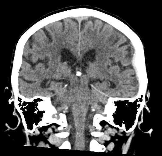 File:Acute traumatic subdural hematoma (Radiopaedia 82921-97257 Coronal non-contrast 54).jpg
