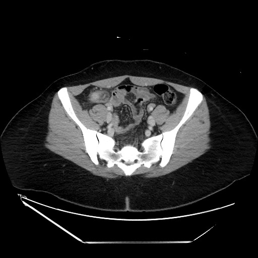 File:Acute uncomplicated appendicitis (Radiopaedia 73704-84499 Axial C+ portal venous phase 124).jpg