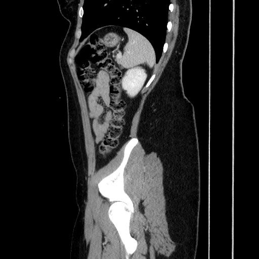 Acute uncomplicated appendicitis (Radiopaedia 73704-84499 Sagittal C+ portal venous phase 156).jpg