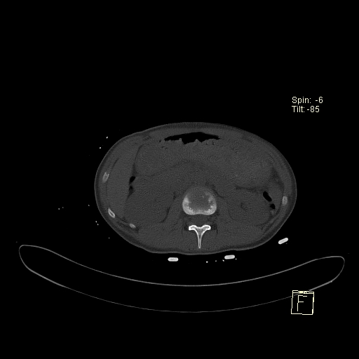 File:Acute vertebral compression fracture (Radiopaedia 63832-72559 Axial bone window 20).jpg