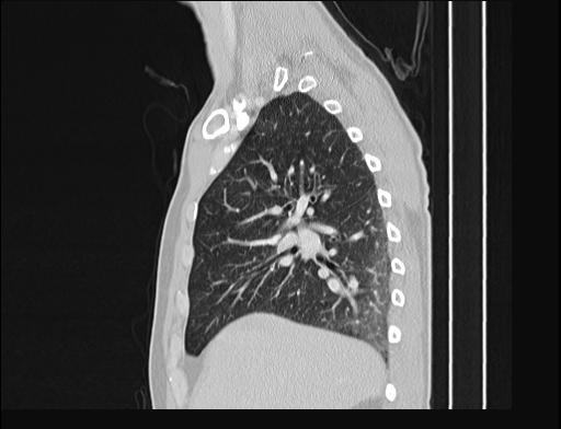 Addison disease (Radiopaedia 49318-54412 Sagittal lung window 43).jpg