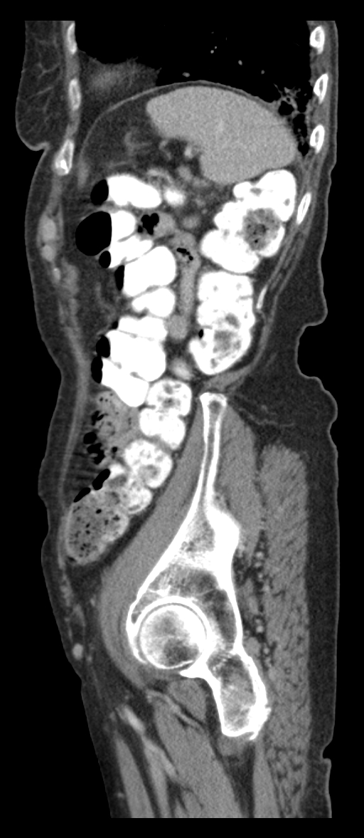 Adenocarcinoma of cecum (Radiopaedia 59222-66549 Sagittal C+ portal venous phase 12).jpg