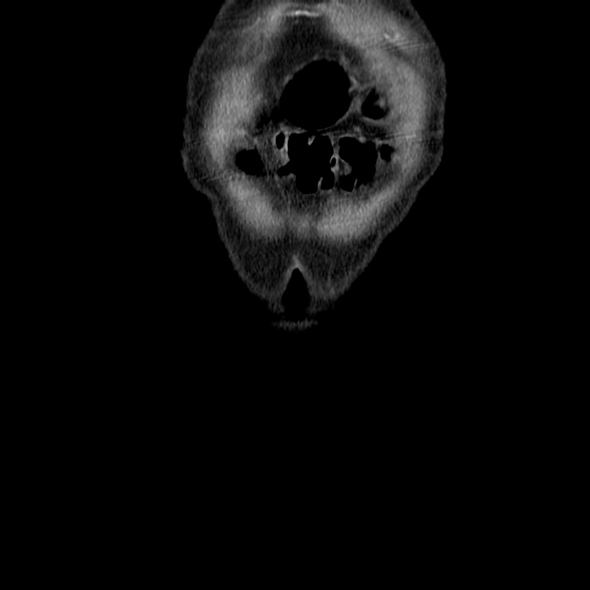 Adenocarcinoma of colon with entero-colic fistula (Radiopaedia 22832-22852 Coronal C+ portal venous phase 4).jpg