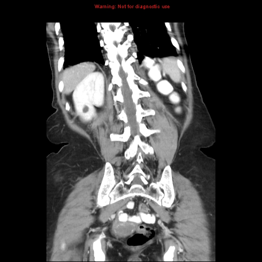 File:Adenocarcinoma of the colon (Radiopaedia 8191-9039 Coronal liver window 37).jpg