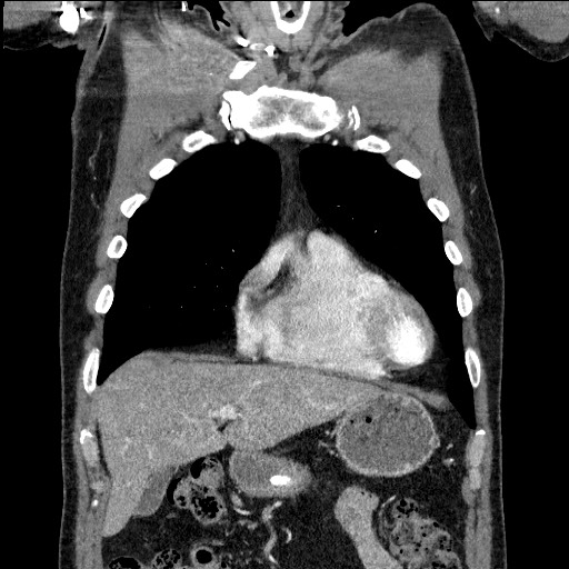 Adenocarcinoma of the lung (Radiopaedia 59871-67325 Coronal C+ arterial phase 15).jpg