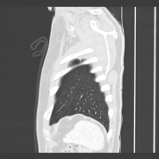 Adenocarcinoma of the lung (Radiopaedia 59871-67325 Sagittal lung window 92).jpg