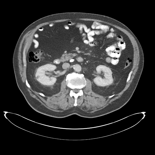 File:Adenocarcioma of rectum- T1 lesion (Radiopaedia 36921-38547 Axial C+ portal venous phase 38).png
