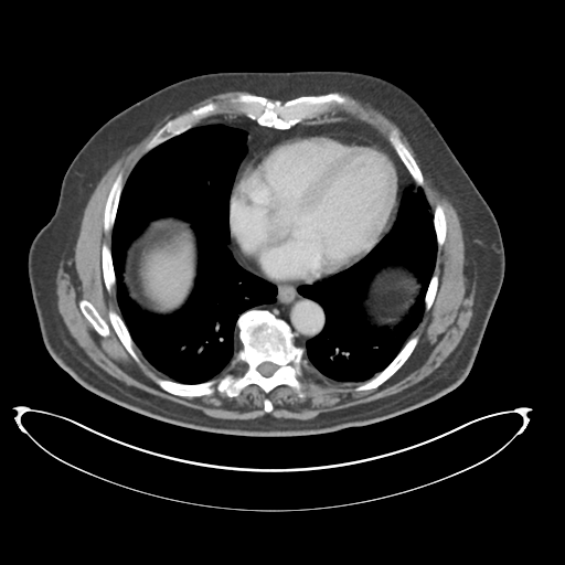 Adenocarcioma of rectum- T1 lesion (Radiopaedia 36921-38547 Axial C+ portal venous phase 7).png