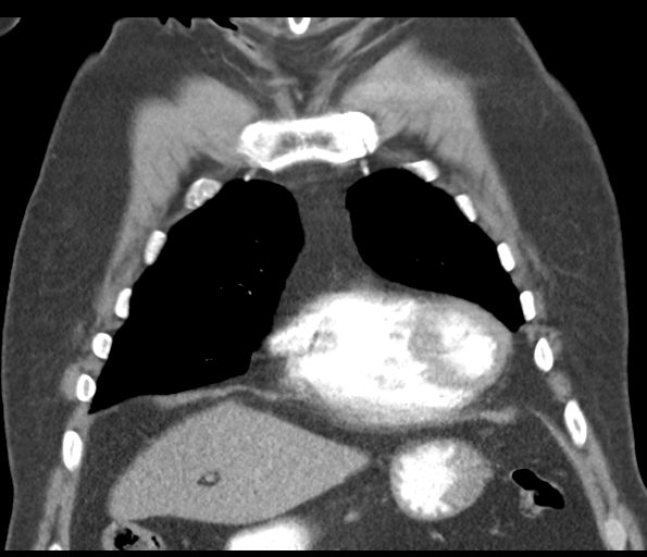File:Adenocarcioma of rectum- T1 lesion (Radiopaedia 36921-38547 Coronal C+ arterial phase 19).png