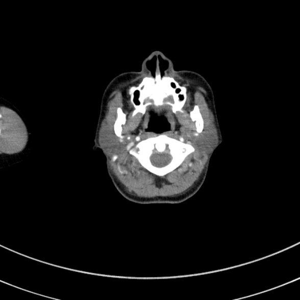 Adenocystic carcinoma of the trachea (Radiopaedia 47677-52525 Axial C+ arterial phase 7).jpg