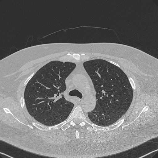 Adenoid cystic carcinoma of the trachea (Radiopaedia 49042-54137 Axial lung window 109).jpg
